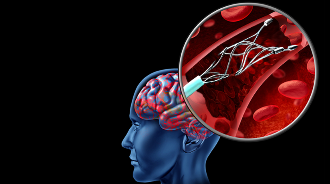stent-403500-edited.png