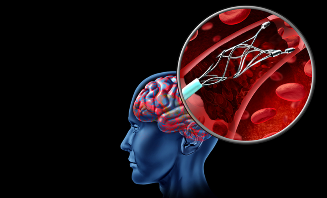 Aspiration-based Thrombectomy Alone As Effective As Thrombectomy with Stent Retriever in Treating LVO Stroke? [Study]